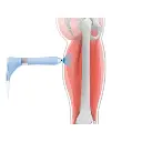 Terapia de ondas de choque radiales PRO BTL-6000-RSWT-PRO (1).webp